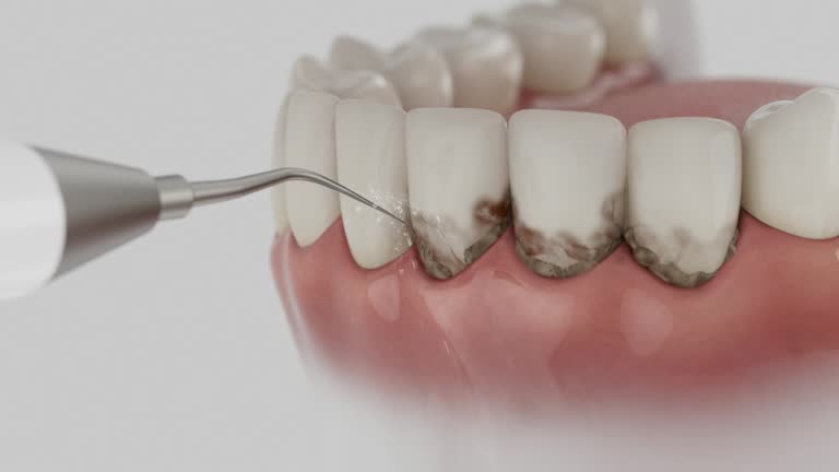 Trusted Wisdom Tooth Removal service in Moline, IL - Dentist Open Now